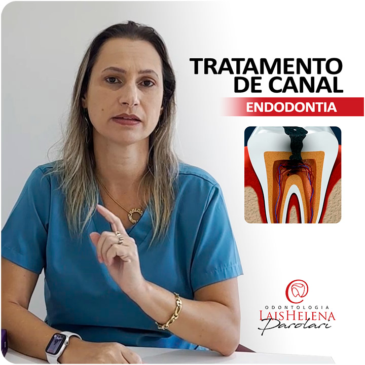 Como saber se é necessário o Tratamento de Canal? - Endodontia - Tratamento Endodôntico