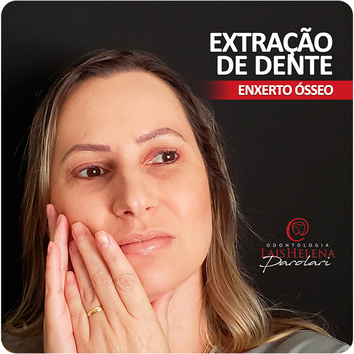 Extração de Dente e Enxerto Ósseo - Novas técnicas e materiais utilizados