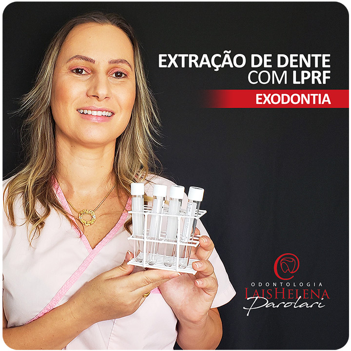 Extração de Dente com a técnica de LPRF - Uma Visão Moderna da Cicatrização