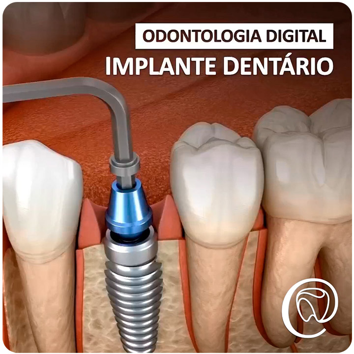 Implante Dentário pela Odontologia Digital - Uma Revolução no seu Sorriso!