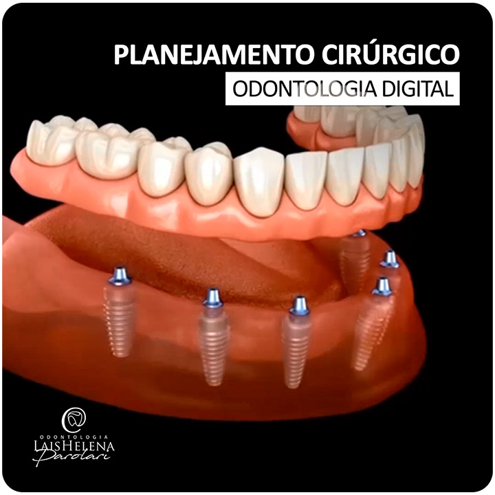 Planejamento Cirúrgico na Odontologia Digital - Escaneamento 3D Intraoral + Tomografia Computadorizada