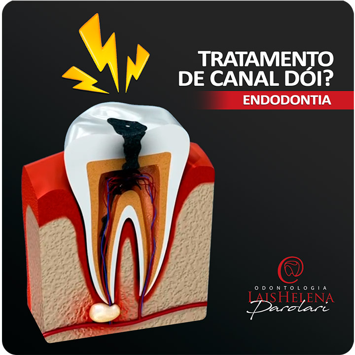 Tratamento de Canal: Desvendando o Mito da Dor - Endodontia sem dor é possível?